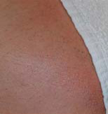 Titan Laser Hair Removal - After (small)