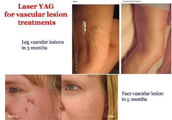 YAG Laser Titan Prima e Dopo per Trattamenti di Lesioni Vascolari