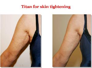 Titan Laser Treatments Before & after - Arms